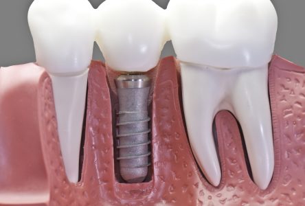 Implants dentaires : est-ce pour tout le monde ?