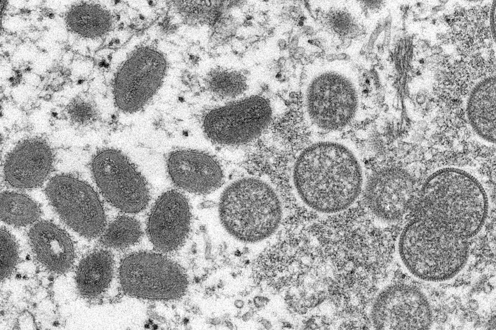 L’éclosion de variole fait craindre une stigmatisation des hommes gais et bisexuels