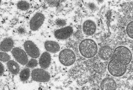 OMS: les cas de variole simienne triplent en deux semaines en Europe