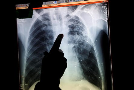 La mortalité due au cancer du poumon est en chute libre au Canada