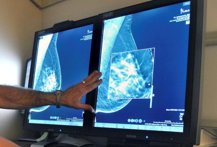 Le dépistage précoce du cancer du sein permettrait d’économiser des millions